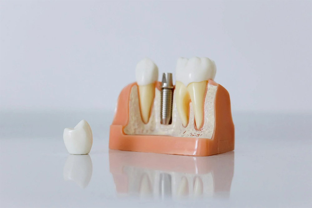 dental crowns and bridges